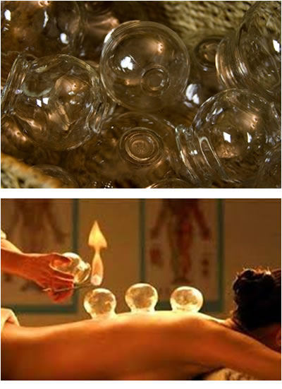 Cupping And Moxibustion Therapy