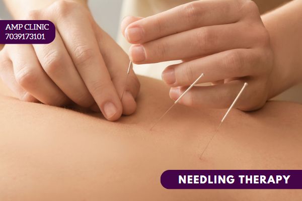 Acupuncture Needling Therapy