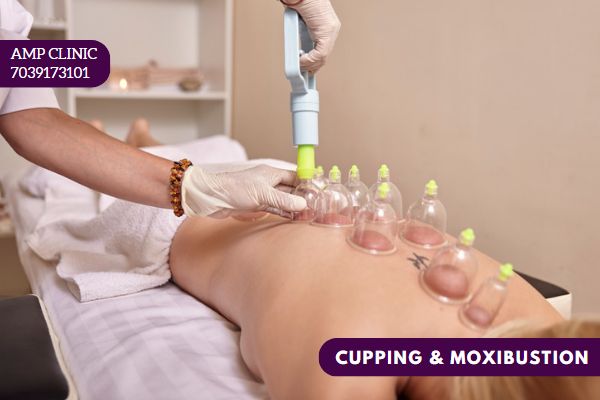 Acupuncture Cupping And Moxibustion Therapy