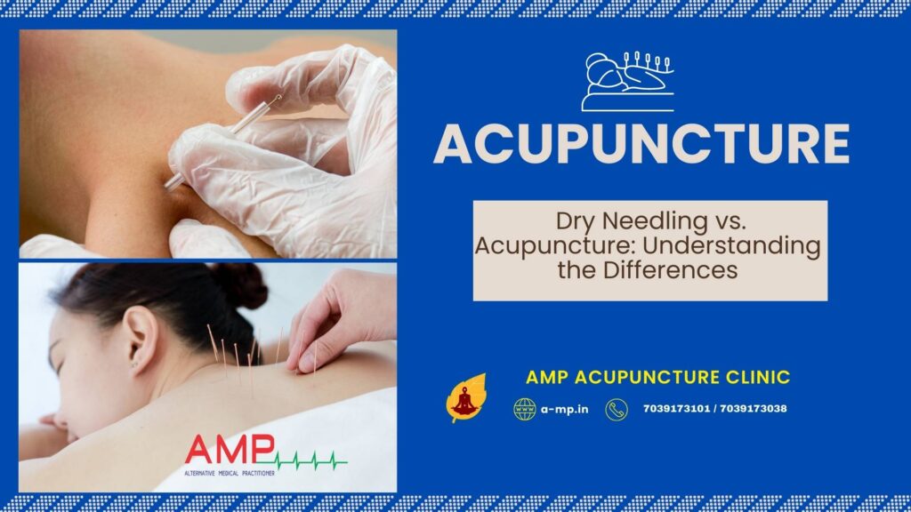 dry needling vs acupuncture