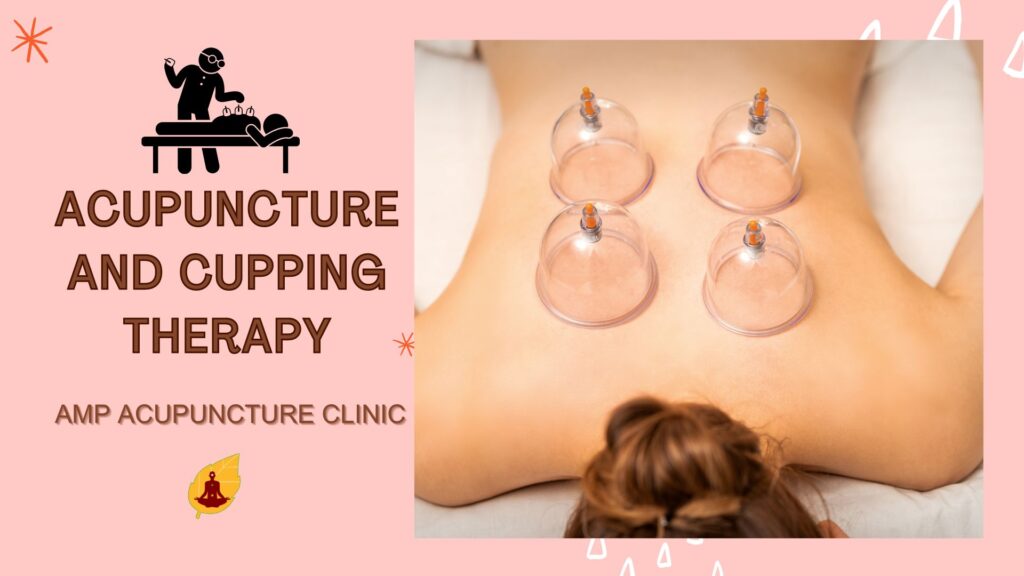 Acupuncture and Cupping Therapy