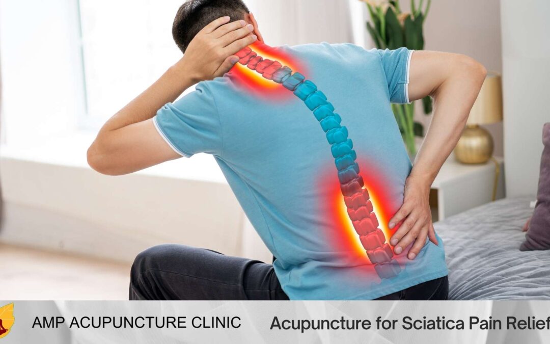 Acupuncture for Sciatica Pain Relief